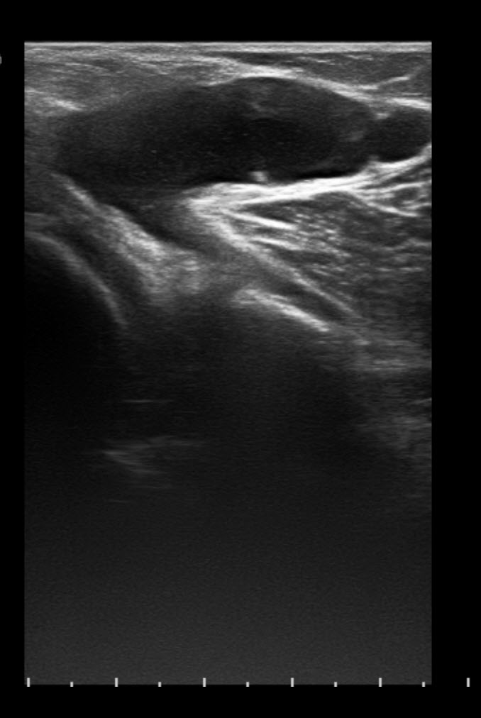 Radiology Station Bakers Cyst