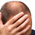 सिर के गंजेपन से राहत के उपाय - Remedy For Baldness of Head In Hindi.