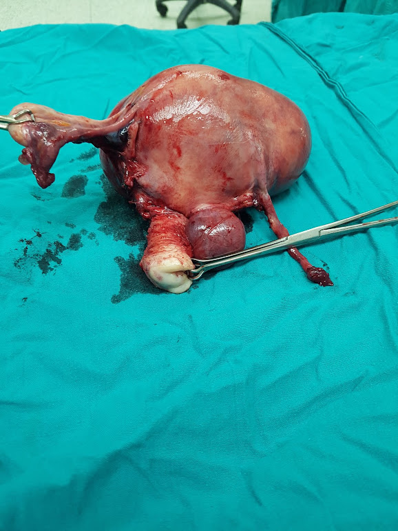 Multiple  uterine fibroid. TAH and BSO was done by Dr. Alaa Mosbah