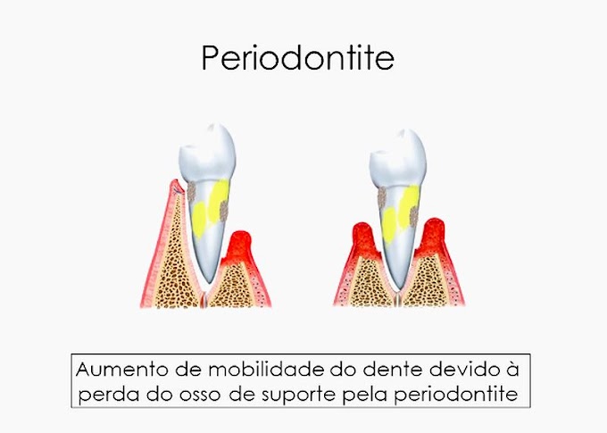 PERIODONTIA: Dentes Moles - Uma História Dramática de Periodontite