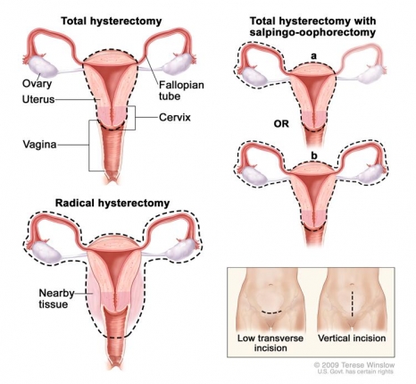 metode pengobatan Oophorectomy yaitu menghilangkan ovarium wanita untuk penyakit jiwa