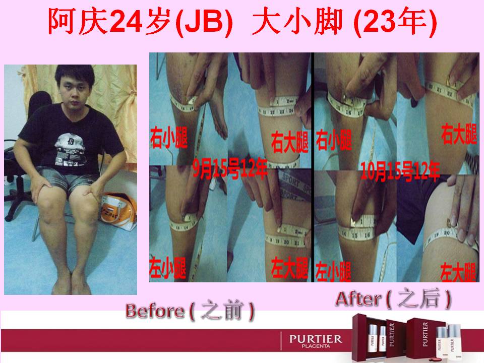 AH CHING (24) JB-UNNORMAL GROWTH OF LEG TISSUE AFTER AN INJECTION NEAR THE BUDTOX FOR 23 YEARS