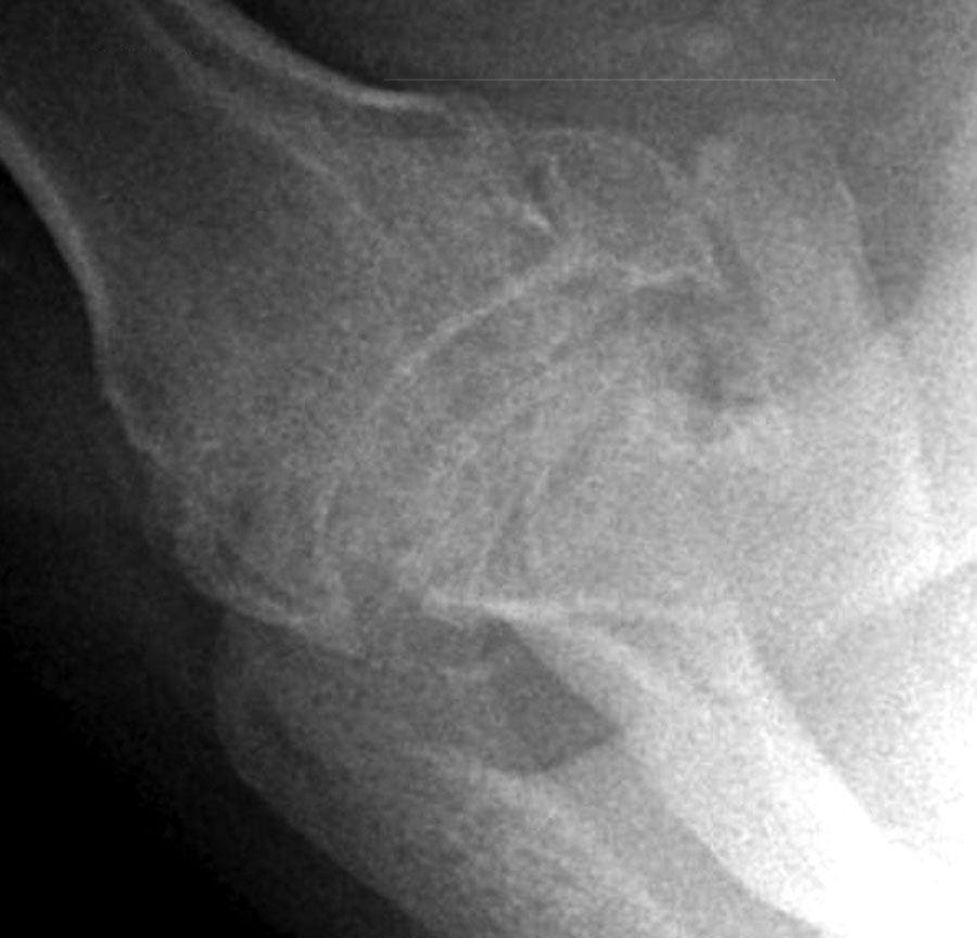 UW Shoulder and Elbow Academy Avascular necrosis of the shoulder, x