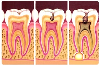 CARIES DENTALES Dibujo de caries dentales