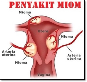 Biaya Operasi Miom atau Mioma Saat Ini Biaya Operasi Miom atau Mioma Saat Ini