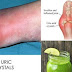 How to Quickly Remove Uric Acid Crystalization From Your Body to Prevent Gout and Joint Pains