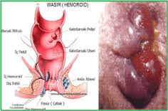 Foto Jual Obat Wasir Bengkak