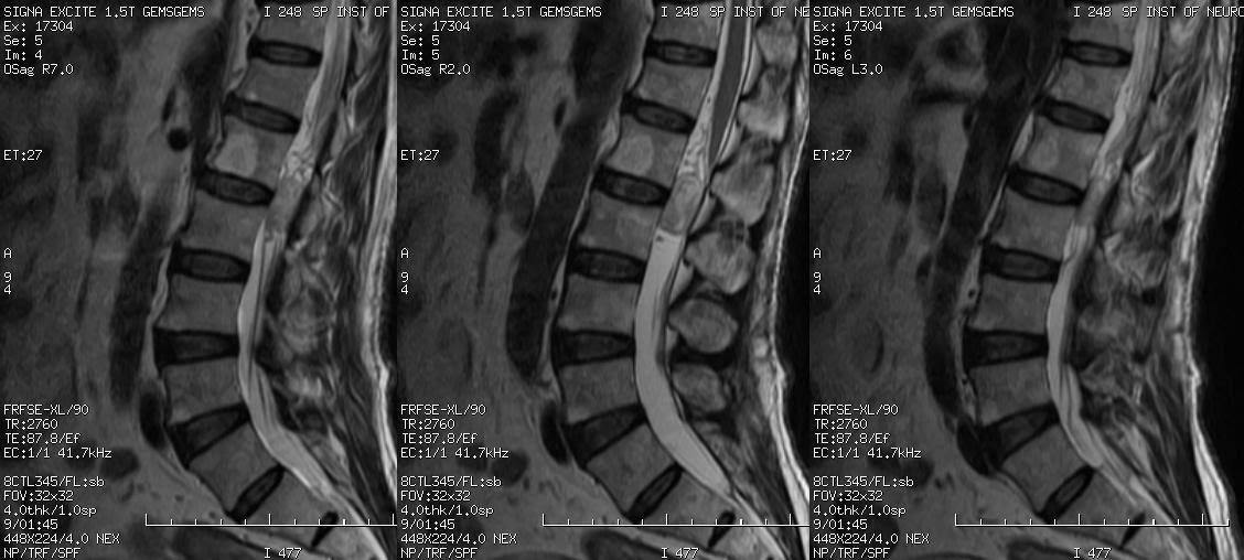 Neuroradiology Cases: Intraspinal mass, a nerve sheath tumor on MRI ...