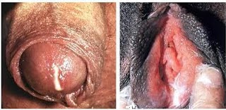 Foto Sipilis Bisa Sembuh Gak