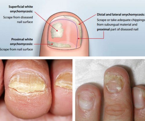 Home Remedy For Dog Nail Infection Home Remedy For Dog Nail Infection