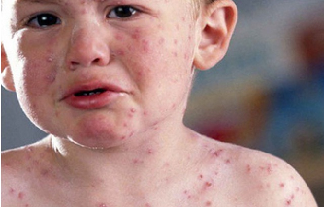 Ciri Dan Gejala Serta Pengobatan Campak Rubella Serta Bagaimana Bahayanya Kepada Anak Balita? Ciri Dan Gejala Serta Pengobatan Campak Rubella Serta Bagaimana Bahayanya Kepada Anak Balita?