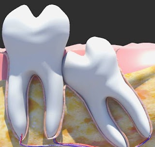 Tìm hiểu răng khôn là răng nào? Bf%25C4%2591
