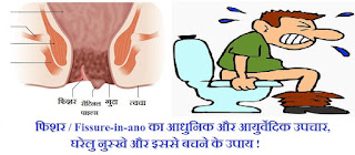 fissure treatment ayurvedic home remedies in Hindi language