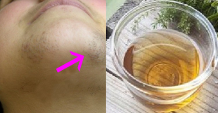 La caída de los cabello el tratamiento al niño