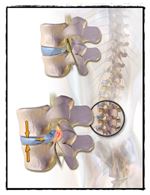 Hernia Discal Hernia Discal