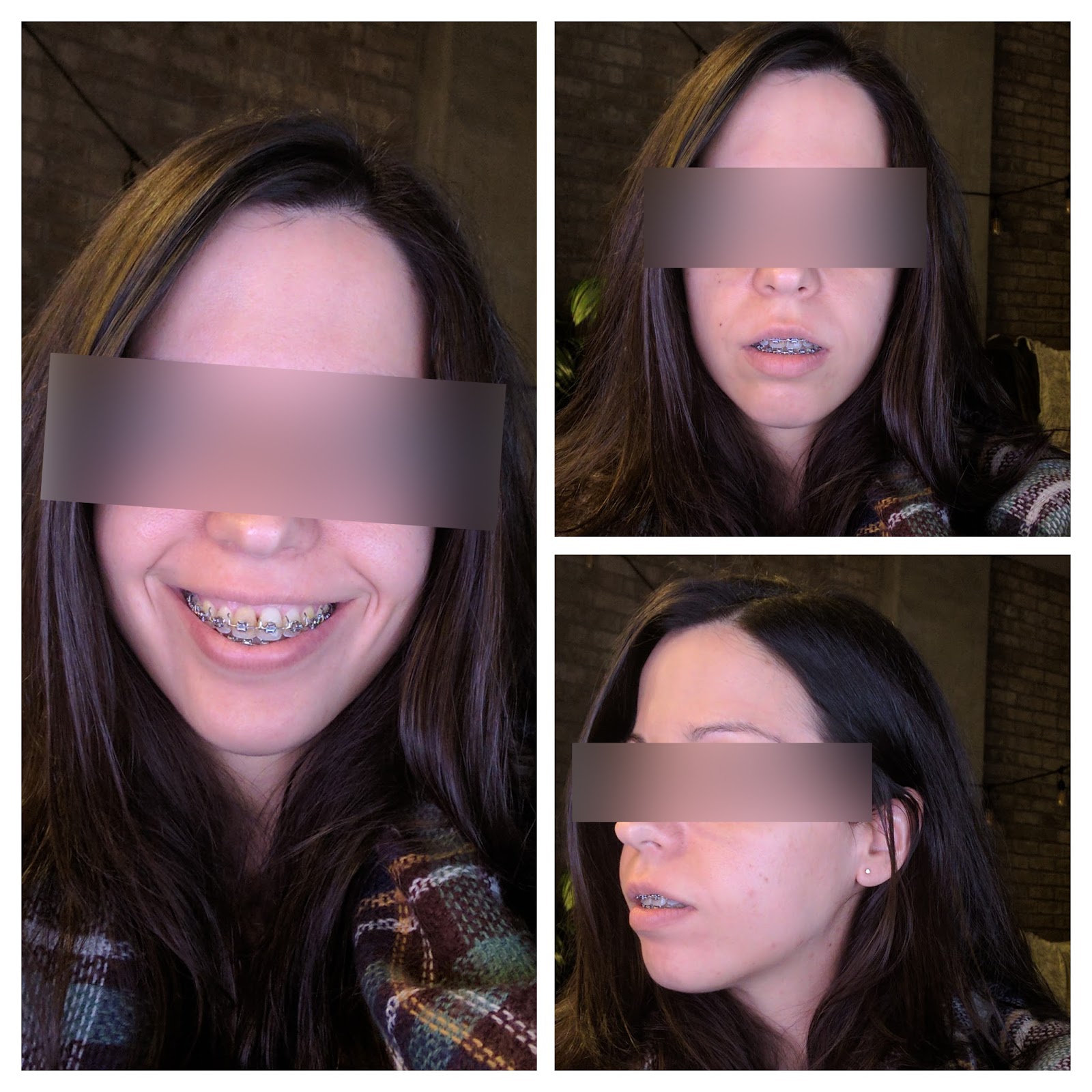 My Story Double Jaw Surgery and Septoplasty Photos