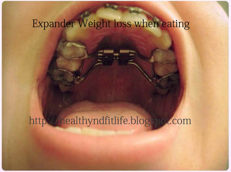 How to help Palatal Expander Weight loss when eating Healthy and fit Life