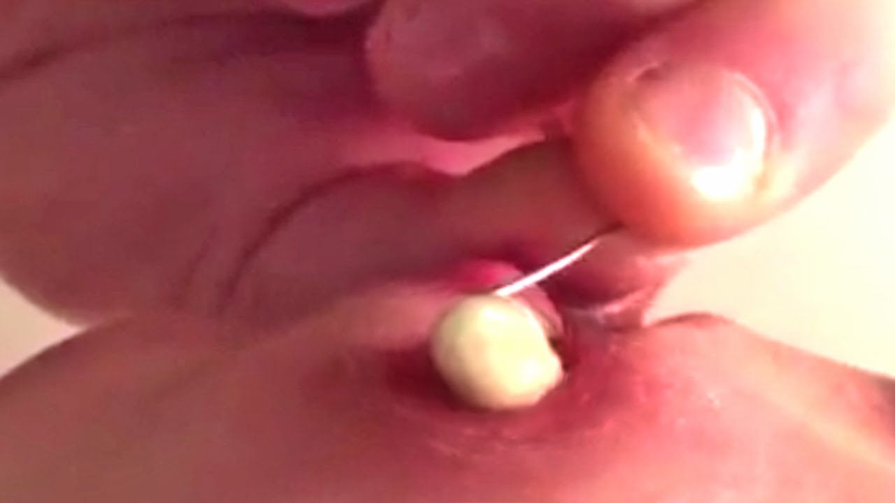 Zit Treatment Natural Zit Treatment Natural