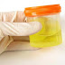 7 Amazing Benefits Of Urine Therapy For Different Health Complications