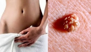 Image Bahaya adanya benjolan kecil di sekitar vagina