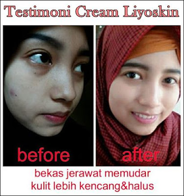 Cream Penghilang Flek Hitam Akibat Genetik/Keturunan Liyoskin Cream Penghilang Flek Hitam Akibat Genetik/Keturunan