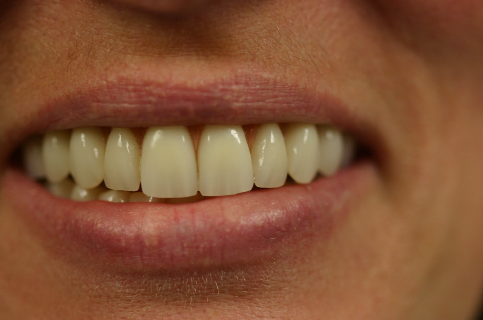 Dr. Robert G. Tupac Prosthodontics Tooth Position and Lip Support