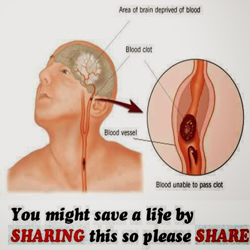 The warning signs of a stroke