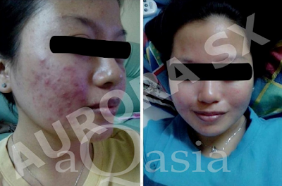 aurora sx testimoni 5