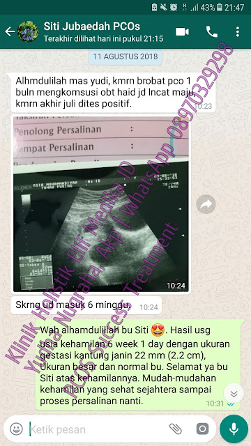 pcos pcos bisa hamil