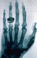 Fuente: https://upload.wikimedia.org/wikipedia/commons/thumb/f/fb/X-ray_by_Wilhelm_R%C3%B6ntgen_of_Albert_von_K%C3%B6lliker's_hand_-_18960123-02.jpg/250px-X-ray_by_Wilhelm_R%C3%B6ntgen_of_Albert_von_K%C3%B6lliker's_hand_-_18960123-02.jpg
