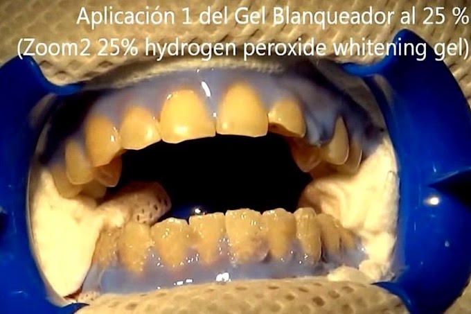 Blanqueamiento Dental Zoom paso a paso