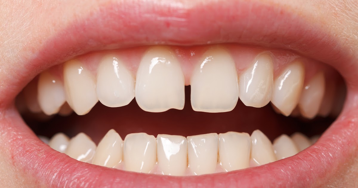 Diastema (Teeth Gaps) which is the best treatment option