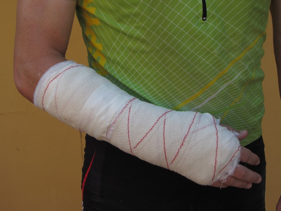 Los tipos de fracturas, salud y deporte