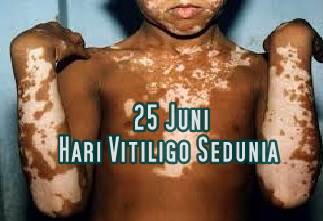 Sejarah Hari Vitiligo Sedunia Diperingati Tanggal 25 Juni Sejarah Hari Vitiligo Sedunia Diperingati Tanggal 25 Juni