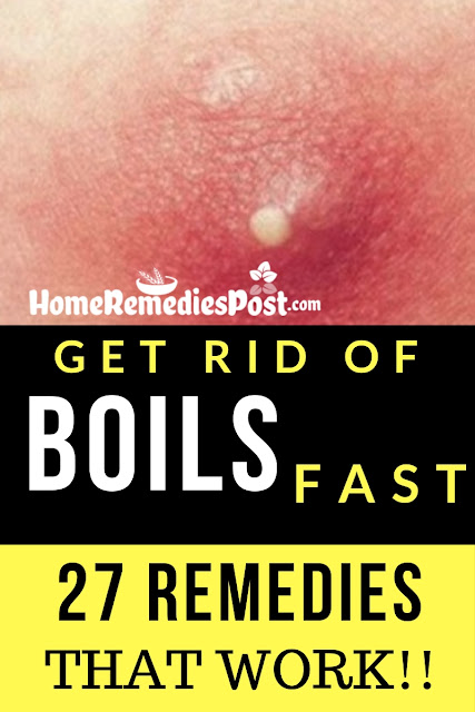 27 Home Remedies For Boils That Really Work Boils, How To Get Rid Of Boils, Home Remedies For Boils, Boils Treatment, Boils Home Remedies, How To Treat Boils, How To Cure Boils, Boils Remedies, Remedies For Boils, Cure Boils, Treatment For Boils, Best Boils Treatment, Boils Relief, How To Get Relief From Boils, Relief From Boils, How To Get Rid Of Boils Fast, Herbal-Remedies-For-Boils