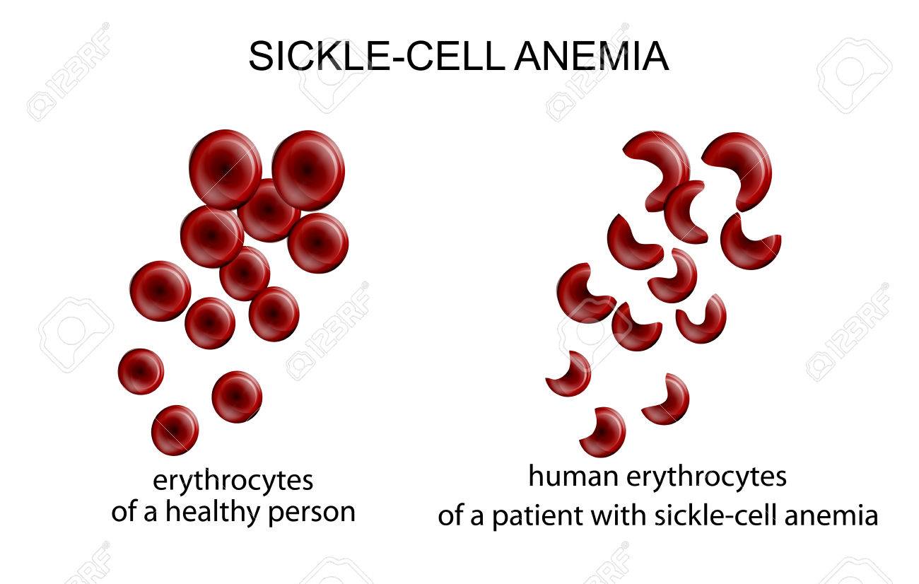 example case study of sickle cell anemia