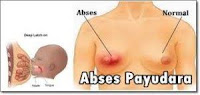 Abses Payudara Abses Payudara
