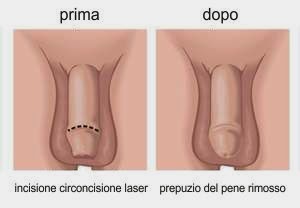 operazione per erezione silicone implants