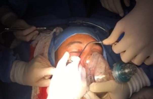 doctors remove grenade soldiers face