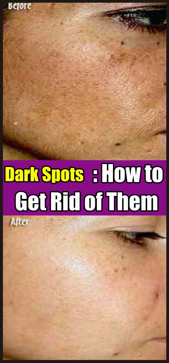 Dark Spots How to Get Rid of Them beauty4everything
