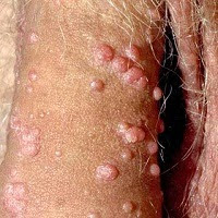 Foto Harga Obat Jamur Kutil Kelamin Denature