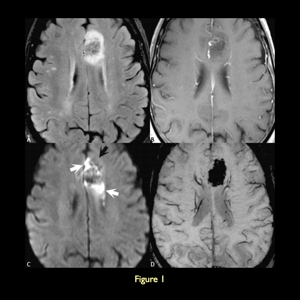 MRI BLOG: Susceptibility Weighted Imaging (II/II) - Image Gallery