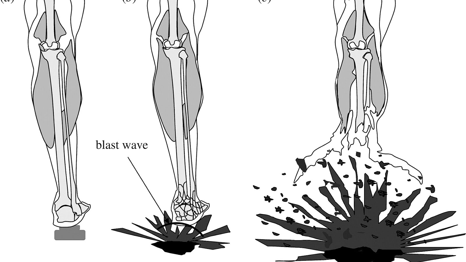 Tertiary Blast Injury Injury Choices