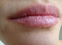 cara mengatasi bibir kering dan pecah pecah bibir kering