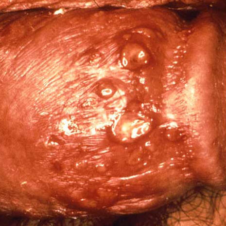 Hardin MD : Genital Herpes Pictures