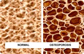  merawat osteoporosis