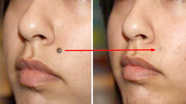 Natural Ways To Get Rid Of Moles On Skin Natural Ways To Get Rid Of Moles On Skin