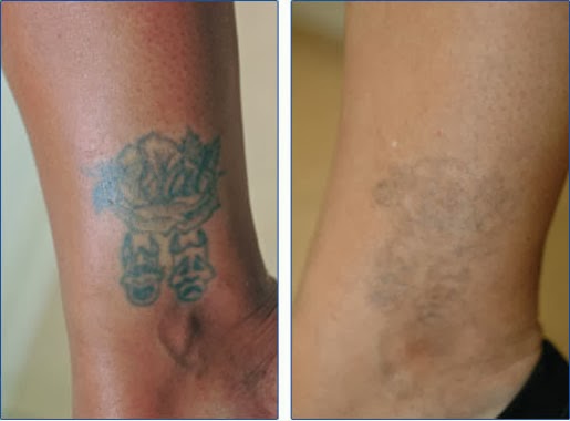 Natural Tattoo Removal: How To Remove Tattoos At Home - Dermabrasion
