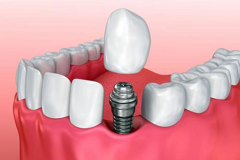 IMPLANTES DENTALES : Lo que hay que saber sobre implantes dentales ...