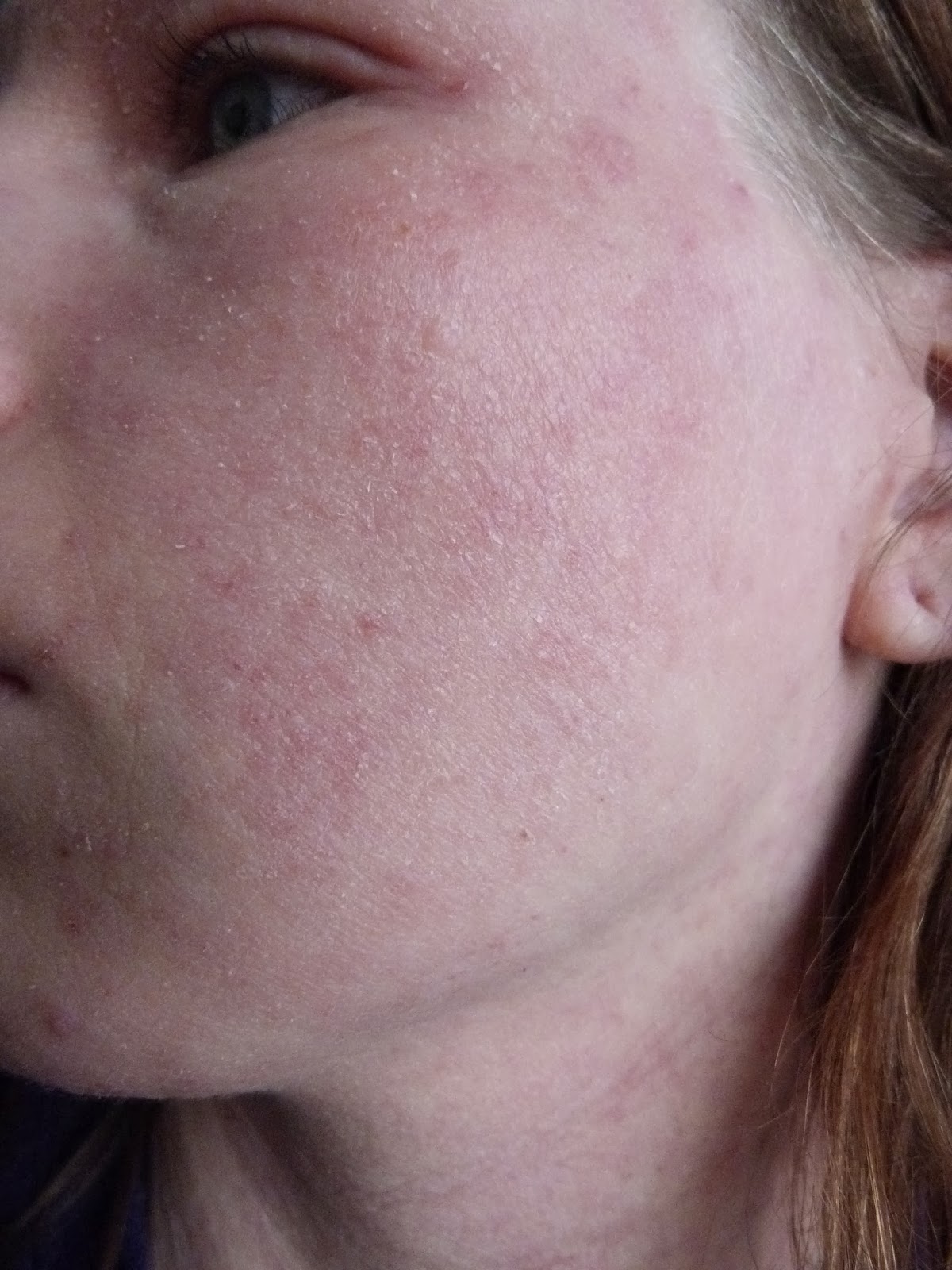 I Have Eczema: Photo of Eczema Skin 5 Months Topical Steroid Withdrawal